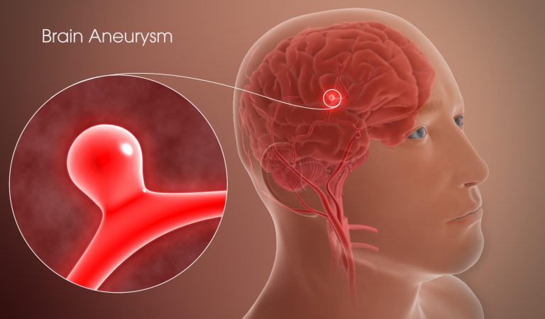 Aneurysm: Signs You Shouldn’t Ignore Aneurysm: Signs You Shouldn’t Ignore