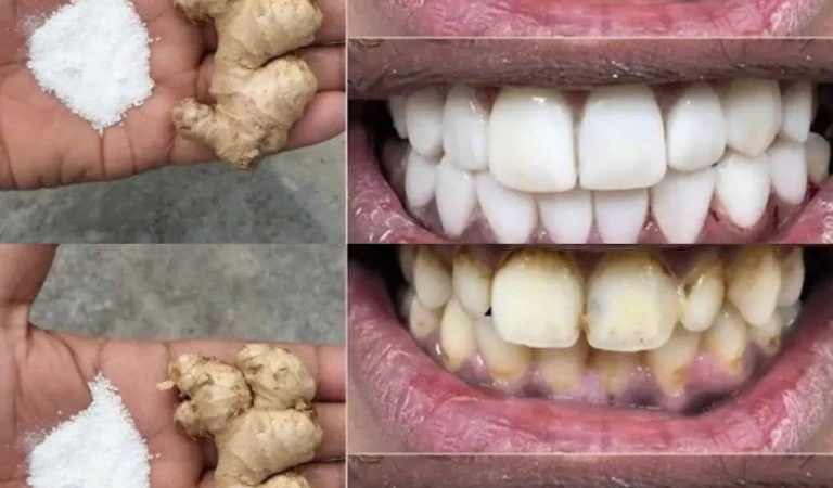 Whiten Your Teeth in 2 Minutes – Home Remedy with Ginger & Salt